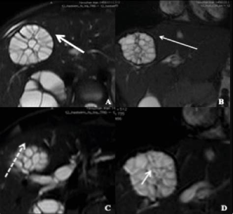 Figure 1 From A Rare Cause Of Obstructive Jaundice In Adolescent Patient Ruptured Hydatid Cyst