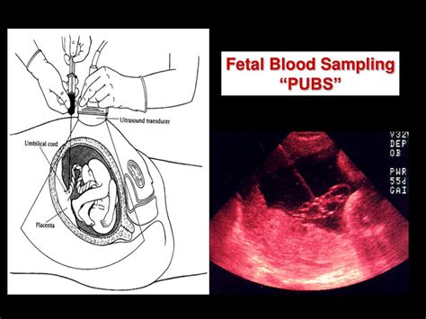 Ppt Tools Of Prenatal Diagnosis Powerpoint Presentation Free