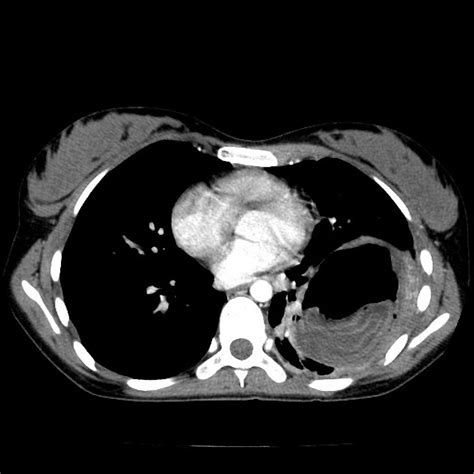 Hydatid disease | Radiology Reference Article | Radiopaedia.org