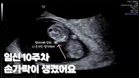 임신10주 한 주나 작았었는데 주수에 맞게 훌쩍 컸어요 아기가 주수보다 작아요 아기가 작아요 10주 태아 10주초