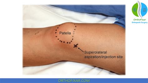 Knee Injection Technique Easy Tutorial Orthofixar