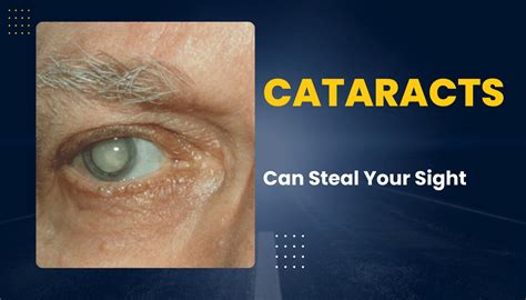 vision loss cataracts