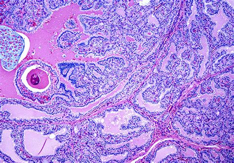 Thyroid Adenoma Histology