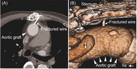 A And B Computed Tomographic Images At 6 Months Postoperatively Download Scientific Diagram