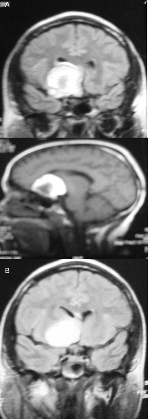 Ruptured Frontal Dermoid Cyst An Unusual Cause Of Seizure In A