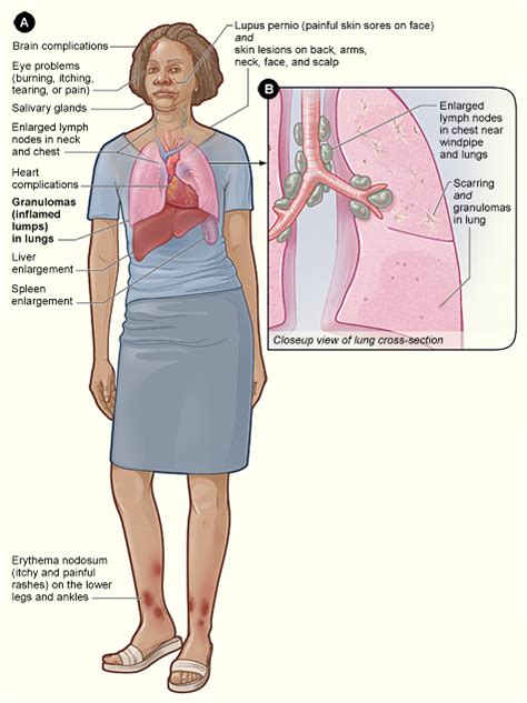 Sarcoidosis Creationwiki The Encyclopedia Of Creation Science