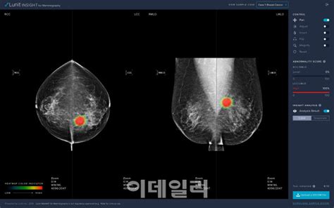 루닛 Ai 유방암 검출 솔루션 미국 Fda 허가 ‘국내 최초 팜이데일리