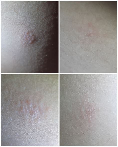 HELP WHAT KIND OF ECZEMA RASH IS THIS? : r/eczema