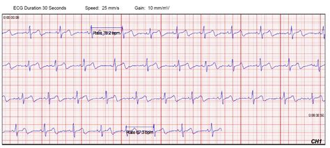 About Electrocardiograms (EKG/ECG) - CardioComm Solutions