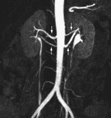 Renal Arteries Computed Tomographic And Magnetic Resonance Angiography