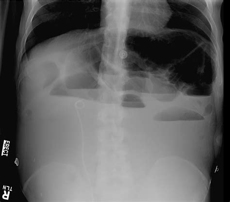 Upright Abdominal Flat Plate X Ray Shows Multiple Upper Abdominal