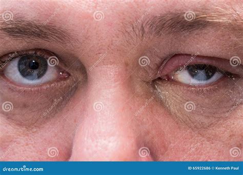 Close up of infected eye stock photo. Image of bacteria - 65922686