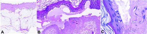 A Histopathology From A Bulla In The Second Case With Epidermal