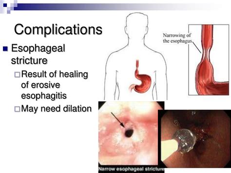 PPT - GERD and Peptic ulcer disease PowerPoint Presentation, free download - ID:3429968