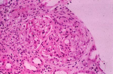 Renal Biopsy Showing Two Glomeruli With Cellular Crescents All