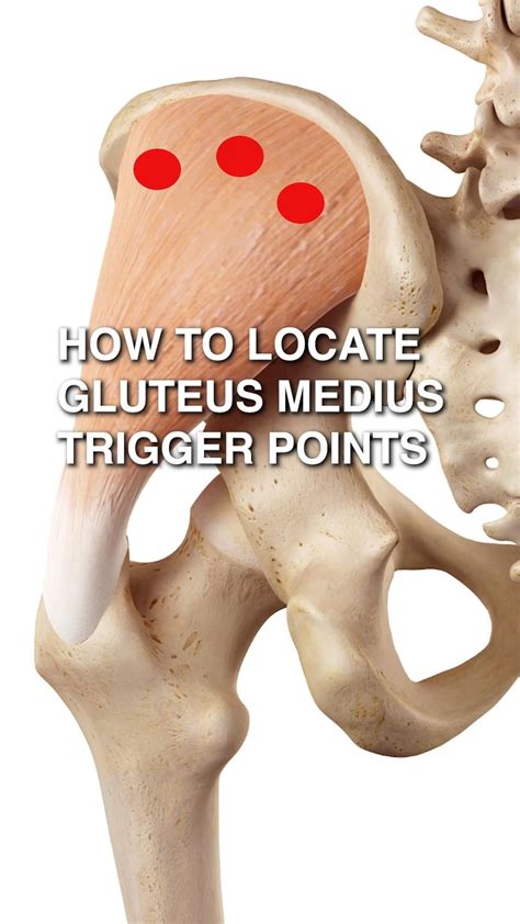 How To Locate Gluteus Medius Trigger Points Artofit