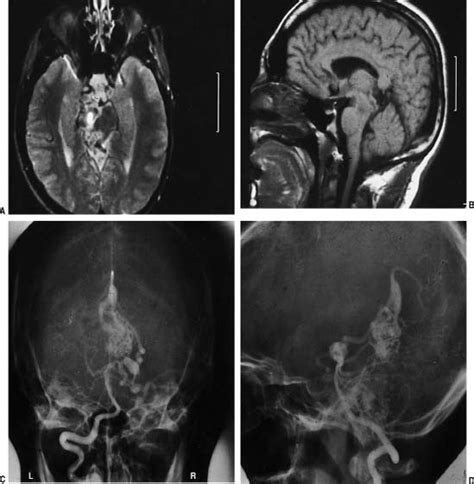 Arteriovenous Malformations Neupsy Key