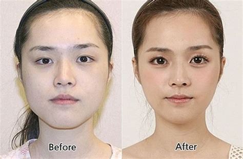 Before and After Plastic Surgery 017 - FunCage