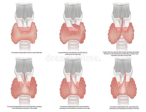 Ilustración De La Clasificación De Las Formas De La Glándula Tiroidea