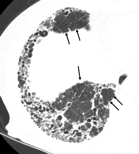 Figure From The Comparison Of High Resolution Computed Tomography