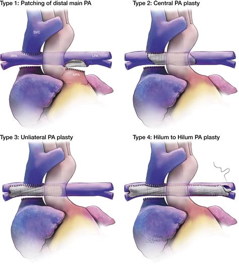 Need For Pulmonary Arterioplasty During Glenn Independently Predicts