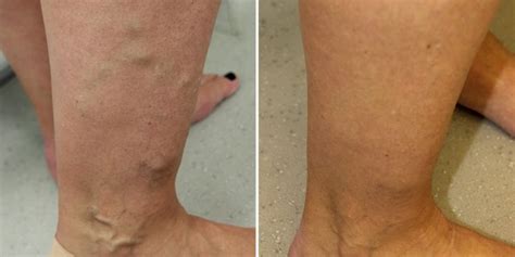 NHS classes varicose veins as cosmetic | London Vein Centre