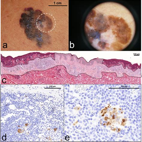 Is It Necessary To Perform Sentinel Lymph Node Biopsy In Thin Melanoma