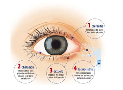 O Que Pode Ser Coceira No Olho Sobre Os Olhos