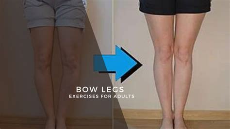 Bow Legs Correction Exercises For Adults - Find Health Tips