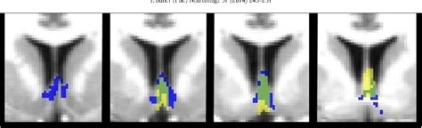 Figure 3 from Comparison of human septal nuclei MRI measurements using automated segmentation ...