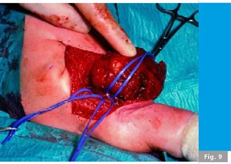 Figure 3 From Congenital Fibrosarcoma A Rare And Curable Tumor Semantic Scholar