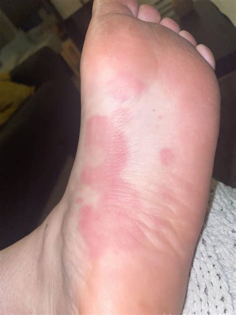 Possible Induced Rashes Reaction On Palms And Soles Gone To The Dermatologist 2 Times To No