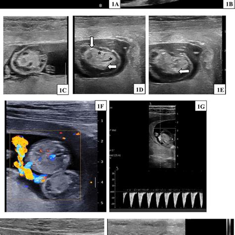 (PDF) Vanishing acardiac twin with TRAP syndrome: A case report