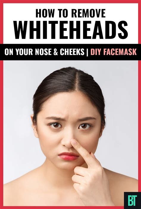 Whiteheads On Nose Face How To Get Rid Of This Acne Problem Diy Artofit