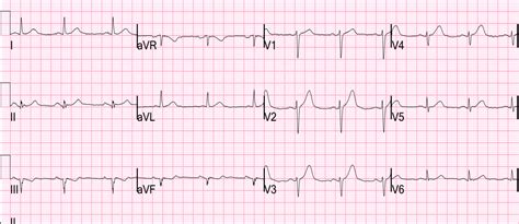 Dr. Smith's ECG Blog: Ten (10) Examples of Hyperacute T-waves in Lead V2 (a few in V3), due to ...