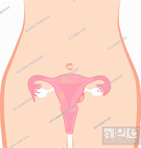 Uterine Fibroid Vector Illustration Gynecology Problem Stock Vector