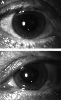 Anterior Uveitis Slit Lamp