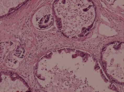 Figure 1 Metastatic Adenocarcinoma With Mucin Production Hematoxylin