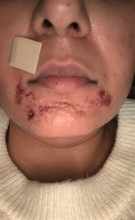 Lactic Acid Peel Burn