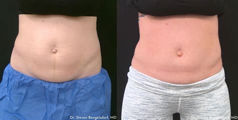 CoolSculpting Franklin TN Franklin Skin And Laser Nashville