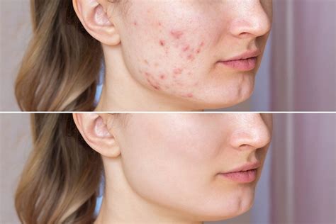 Növényzet Biztonságos Sonka como quitar las cicatrices del acne en los