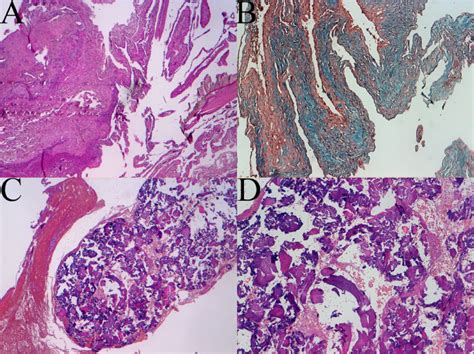 Histologic Patterns Of Meningioangiomatosis A Sclerotic Areas 4