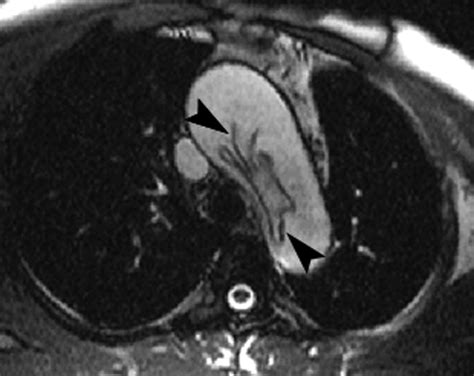 Acute Aortic Dissection With Intimal Intussusception Mri Appearances Ajr