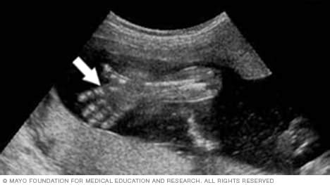 Slide show: Fetal ultrasound - Mayo Clinic