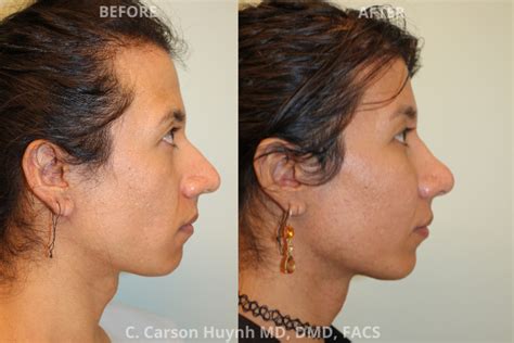 Ffs Feminizing Rhinoplasty Atlanta Nyc Radiance Surgery Aesthetic