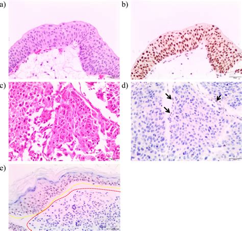 Concurrent Germline And Somatic Pathogenic BAP1 Variants In A Patient