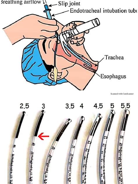 Endotracheal Intubation | PDF