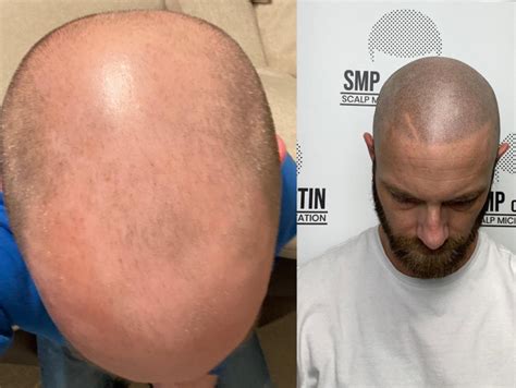 Smp Of Austin Scalp Micropigmentation Clinic In Texas