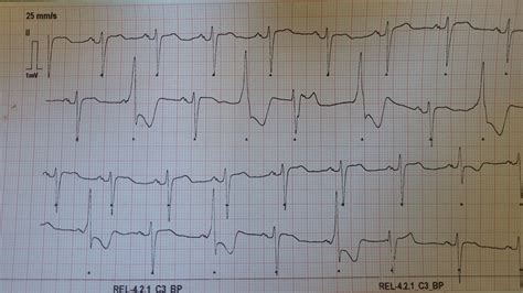 Is this electrical alternans? History in comments. : r/EKGs