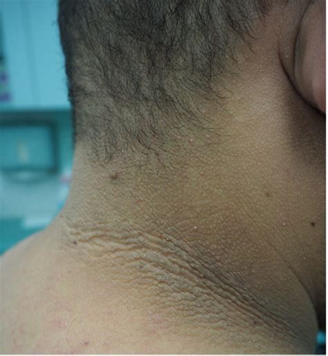 ACD A-Z of Skin - Acanthosis Nigricans